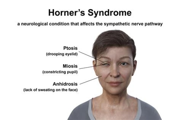 Why ptosis in horner's syndrome?