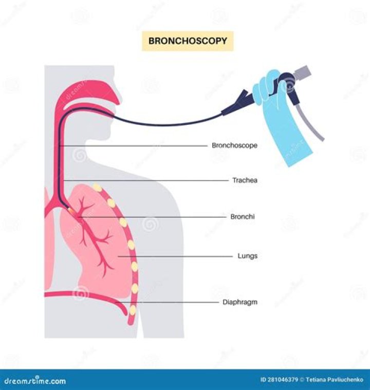 Will a bronchoscopy show lung cancer?