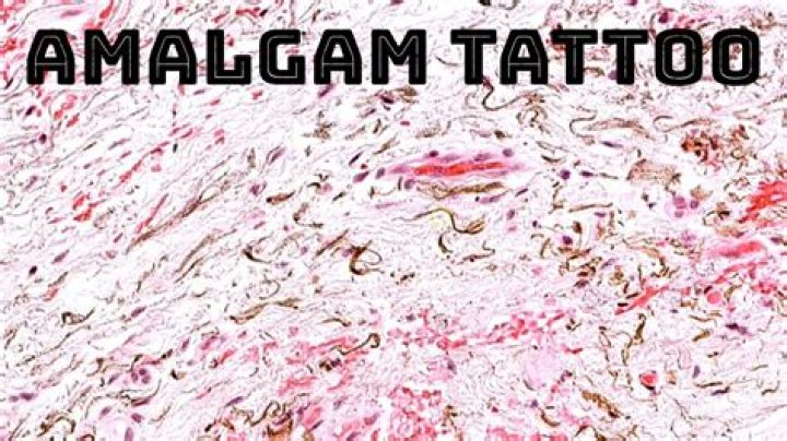 Will amalgam tattoo go away?