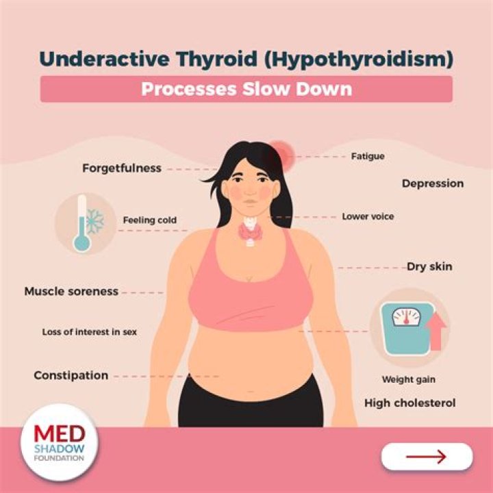 Will i lose weight on hypothyroid meds?